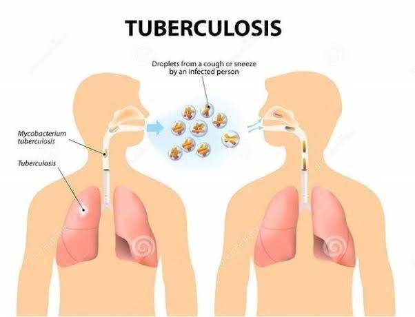 अब नए टीबी मरीजों के परिजनों की सिर्फ तीन माह चलेगी ‘प्रिवेंटिव थेरेपी’